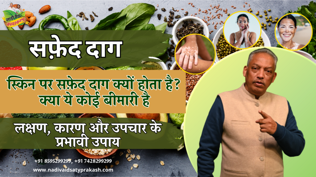 Best Ayurvedic Doctor Treatment for Vitiligo in Rohtak and Delhi